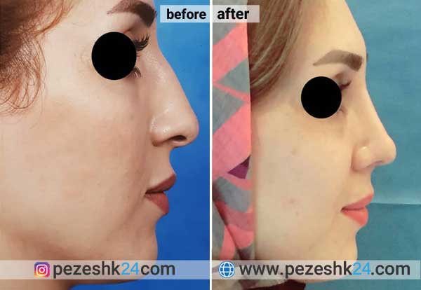 نمونه جراحی بینی دکتر نوریان در شاهرود