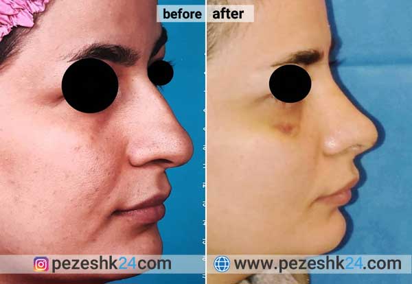 جراحی بینی دکتر نوریان در شاهرود 2