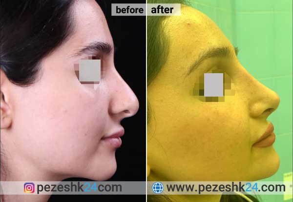 نمونه جراحی بینی دکتر صفائی در شاهرود 3