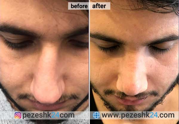 نمونه جراحی بینی دکتر صفائی در شاهرود 4
