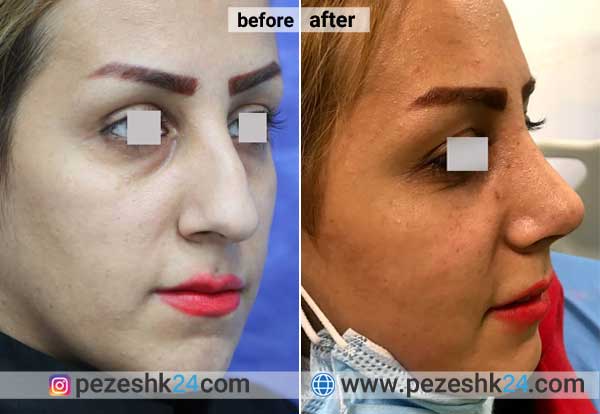 نمونه جراحی بینی دکتر صفائی در شاهرود 2
