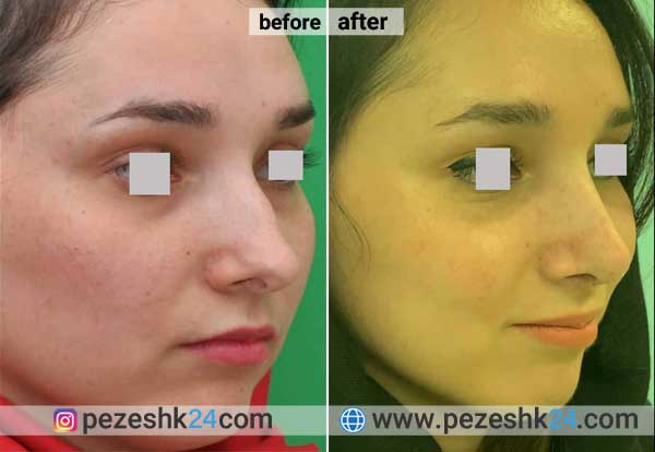 نمونه جراحی بینی دکتر صفائی در شاهرود 1