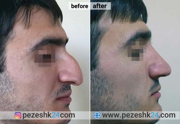 عکس قبل و بعد عمل بینی