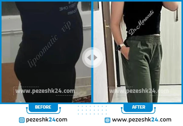 قبل و بعد ابدومینوپلاستی دکتر مروتی