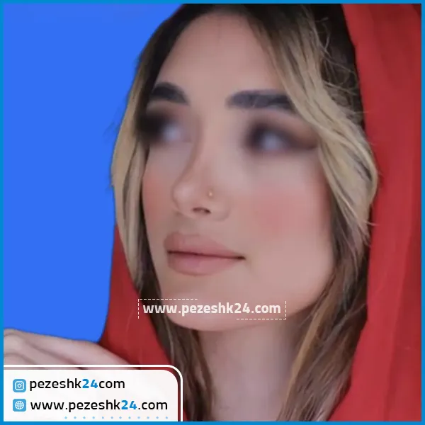 نمونه عمل بینی دکتر قریشی در ساری