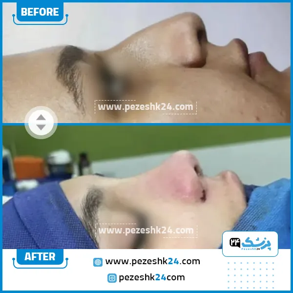 قبل و بعد عمل بینی دکتر قریشی ساری