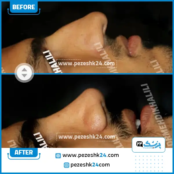 قبل و بعد رینوپلاستی دکتر خلیلی در ساری