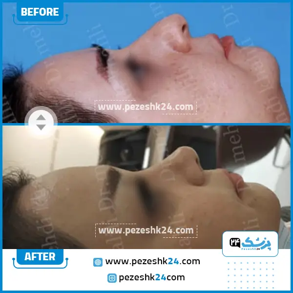 قبل و بعد عمل بینی دکتر خلیلی در ساری