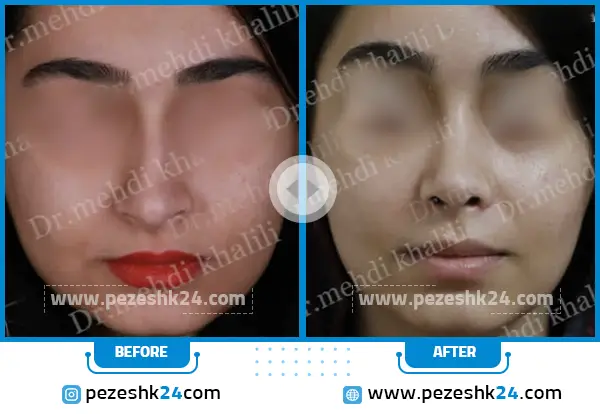 قبل و بعد عمل جراحی بینی دکتر خلیلی ساری