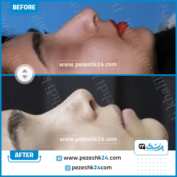 قبل و بعد جراحی بینی دکتر خلیلی ساری