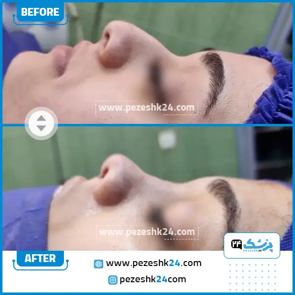 قبل و بعد جراحی بینی دکتر یوسف نژاد