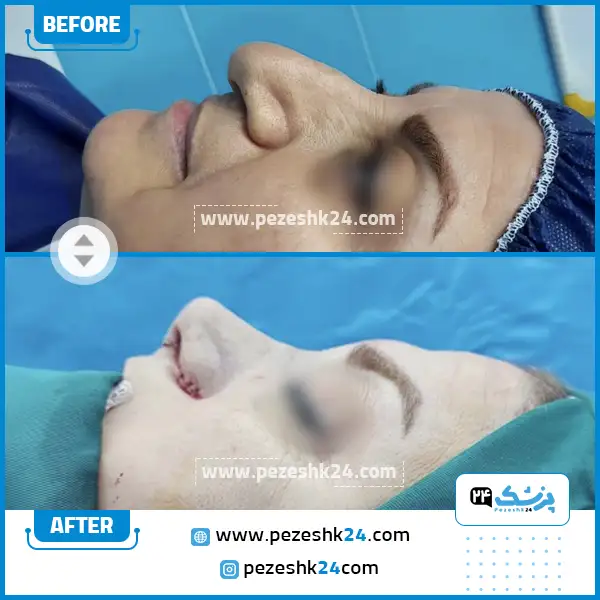 قبل و بعد رینوپلاستی دکتر یوسف نژاد