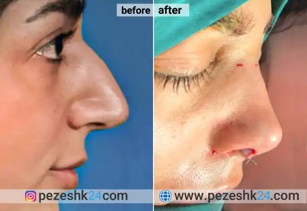 قبل و بعد عمل جراحی بینی دکرت طرزی
