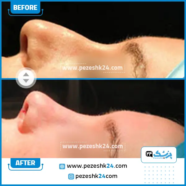 قبل و بعد رینوپلاستی دکتر حسامی در ساری