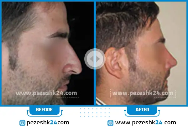 قبل و بعد رینوپلاستی دکتر حسامی ساری