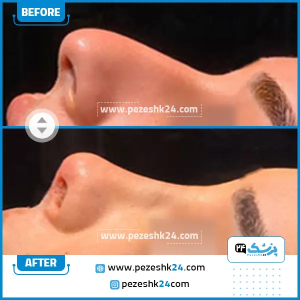 قبل و بعد عمل بینی دکتر حسامی در ساری