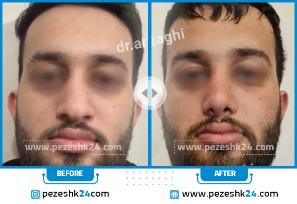 نمونه جراحی بینی دکتر ارزاقی