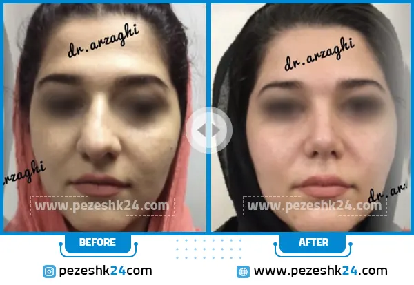 نمونه عمل بینی دکتر ارزاقی ساری