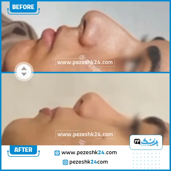 قبل و بعد رینوپلاستی دکتر ارزاقی در ساری