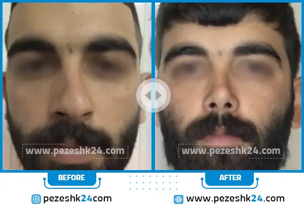 قبل و بعد عمل بینی دکتر ارزاقی در ساری