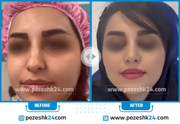 قبل و بعد عمل بینی دکتر حیدری زاده