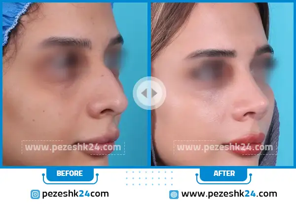 قبل و بعد عمل بینی دکتر جلالی