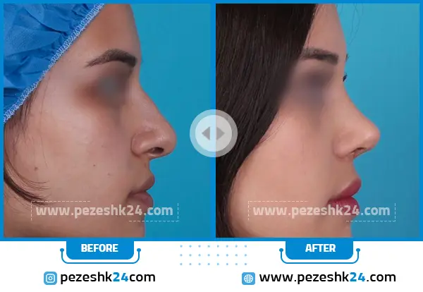 قبل و بعد جراحی بینی دکتر جلالی