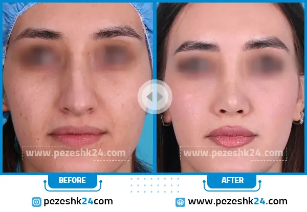 قبل و بعد جراحی بینی دکتر جلالی در اراک