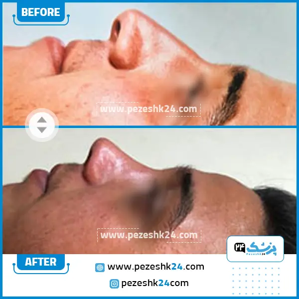 قبل و بعد جراحی بینی دکتر جویباری در ساری