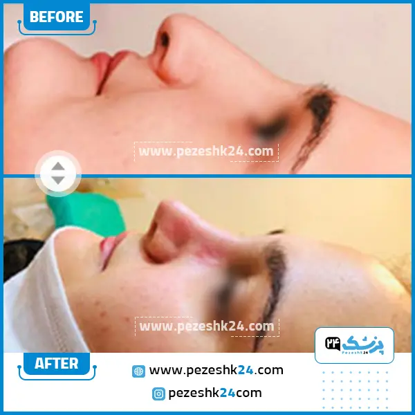 قبل و بعد عمل بینی دکتر جویباری در ساری