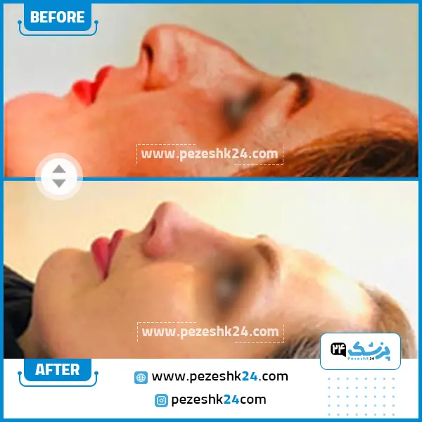 نمونه رینوپلاستی دکتر جویباری در ساری