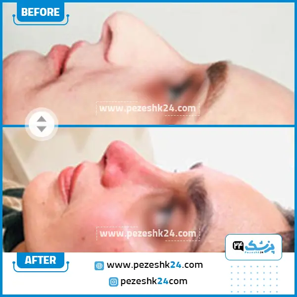 نمونه عمل بینی دکتر جویباری در ساری