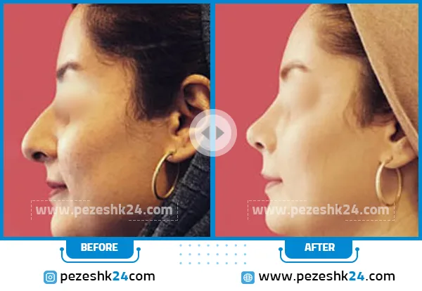 قبل و بعد عمل بینی دکتر محرابی