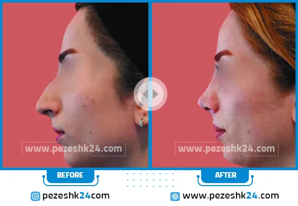 قبل و بعد رینوپلاستی دکتر محرابی در ساری