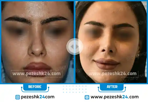 قبل و بعد جراحی بینی دکتر ناصری اراک