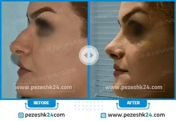 قبل و بعد از جراحی بینی دکتر نرگس ناصری
