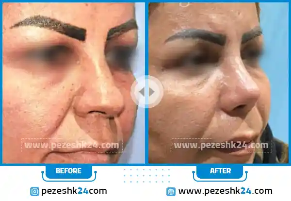 قبل و بعد جراحی بینی دکتر ناصری در اراک