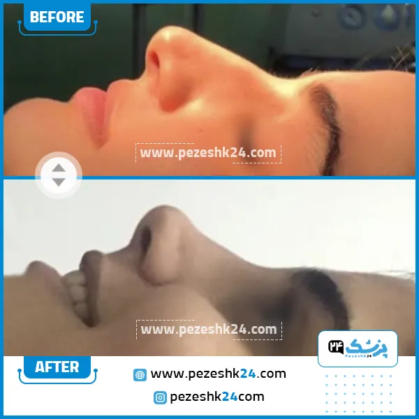 قبل و بعد جراحی بینی دکتر پورموسی ساری