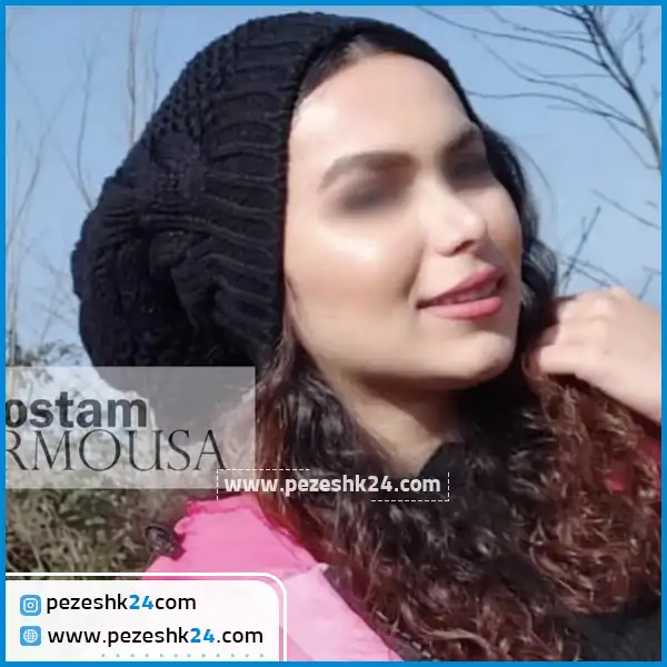 نمونه جراحی بینی دکتر پورموسی ساری