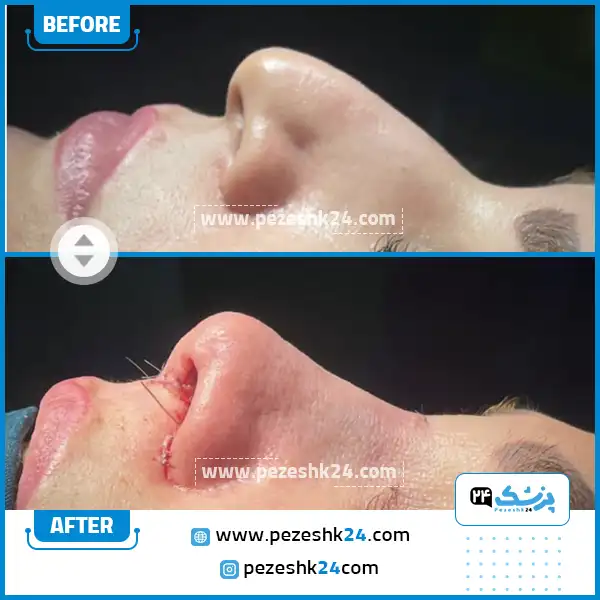 قبل و بعد عمل بینی دکتر پورموسی ساری