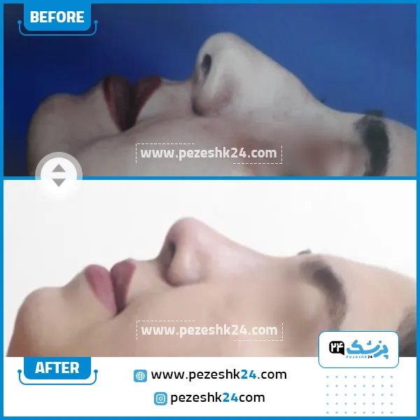 قبل و بعد رینوپلاستی دکتر پورموسی ساری