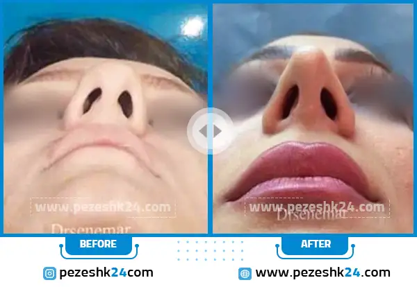قبل و بعد جراحی بینی دکتر سنمار اراک
