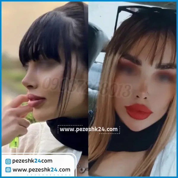 نمونه رینوپلاستی دکتر توکلی ساری