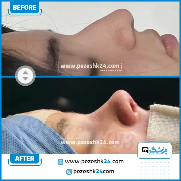 قبل و بعد عمل بینی دکتر توکلی در ساری