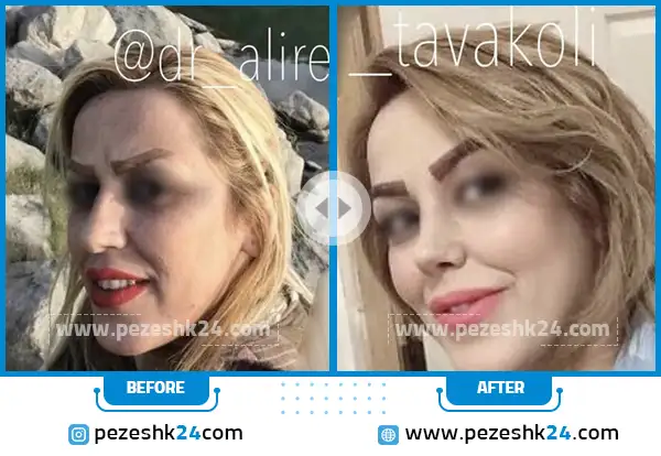 قبل و بعد عمل بینی دکتر توکلی در ساری