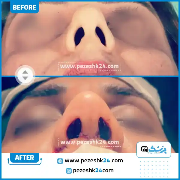 قبل و بعد عمل بینی دکتر یاوری اراک