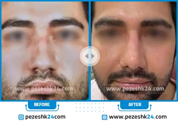 قبل و بعد جراحی بینی دکتر یاوری اراک