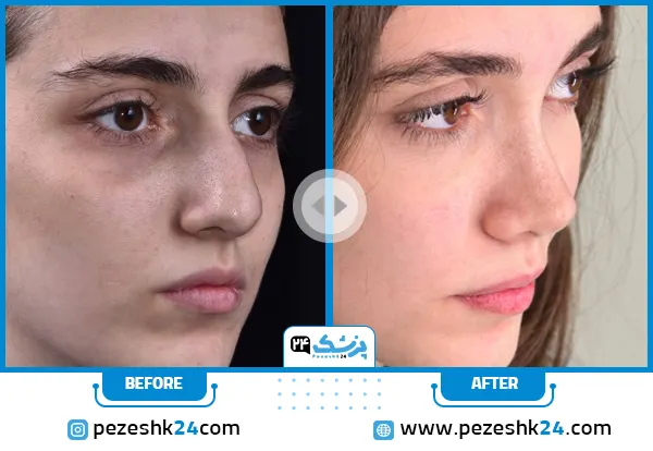 نمونه کار عمل بینی استخوانی طبیعی دکتر سارا ارژنگ در تهران
