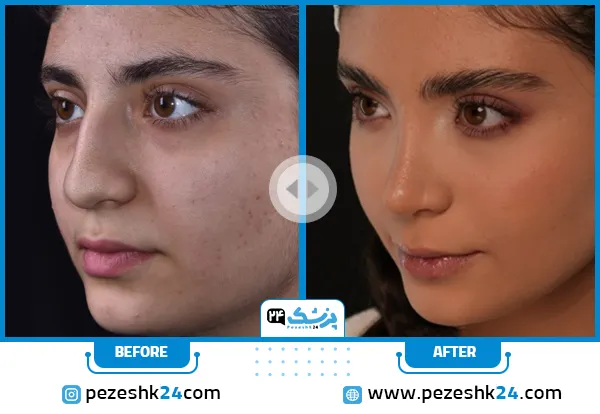 عکس قبل و بعد عمل بینی دکتر سارا ارژنگ در تهران