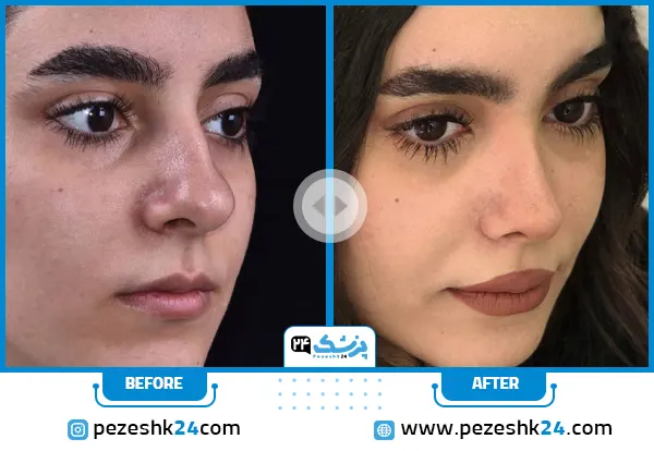 نمونه کار جراحی بینی دکتر سارا ارژنگ در تهران